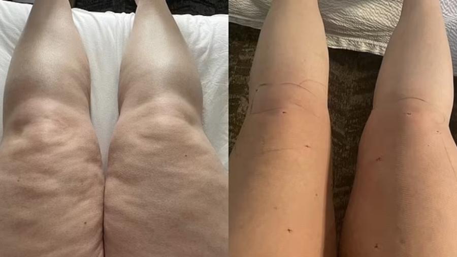 Rodilla — representación antes del protocolo